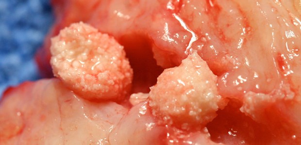 Mehr Pankreatitiden nach HRT Fibrotische Knötchen einer chronischen Pankreatitis: Schwedische Forscher wollen nun einen Zusammenhang zwischen der HRT und akuter Pankreatitis gefunden haben.
