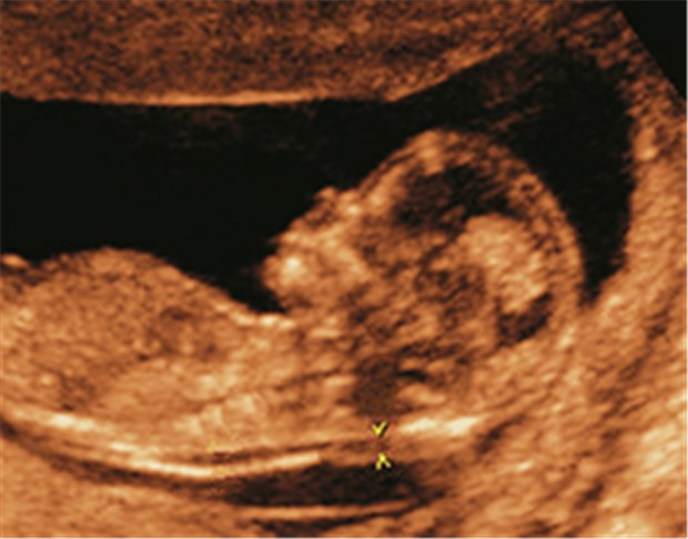Braucht es ein Umdenken in der pränatalen Diagnostik? Fötus in der Frühschwangerschaft mit normaler Nackentransparenz.