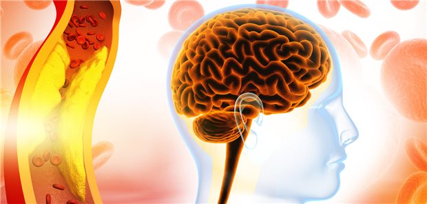 Fokus auf atherosklerotische Plaques: Frühere Studien haben die Aktivierung des Gerinnungsfaktors XII an Stellen mit Gefäßschäden mit der Initiierung der Thrombusbildung an rupturierten Plaques in Verbindung gebracht.