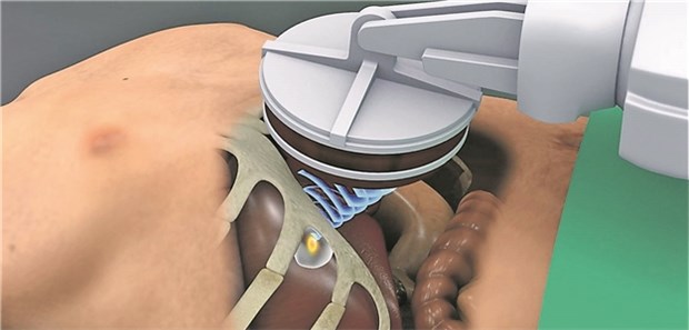 Fokussierter Ultraschall auch gegen Lebertumoren? Fokussierter Ultraschall auch bei Tumoren in Organen, die sich beim Atmen bewegen, etwa die der Leber?