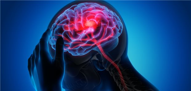 Folgen eines Schlaganfalls im Fokus: US-Forscher konnten Frauen, die aufgrund eines solchen Ereignisses eine Armlähmung hatten, über eine epidurale Stimulation Bewegungen wie Greifen und Essen wieder ermöglichen.