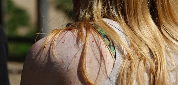 Das Sonnenbad - Gift für die Haut? Folgen eines Sonnenbades? Aus der Art der Hautreaktion lassen sich Rückschlüsse auf die verursachende Strahlung ziehen.