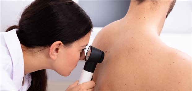 Typ-2-Diabetes verschlechtert Prognose von Männern mit frühem Melanom Eine Ärztin untersucht eine pigmentierte Hautstelle am Rücken eines Mannes.