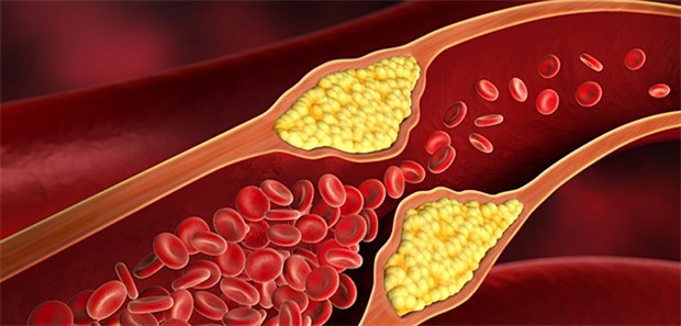 Cholesterin macht Atherosklerose – ganz sicher! Forscher betonen im Konsens: Das "low density lipoprotein" (LDL) und weitere cholesterinhaltige Lipoproteine sind direkt an der Entstehung und dem Fortschreiten der Arteriosklerose beteiligt.