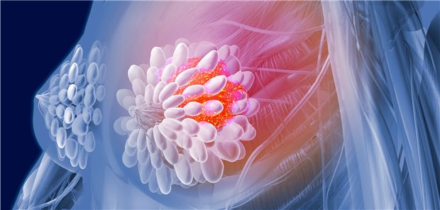 Computerillustration von Brustkrebs.