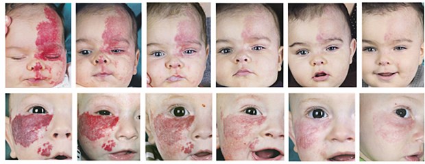 Gib dem Kind Propranolol - und das Hämangiom verschwindet wohl Fotografisch dokumentierter Heilungsverlauf der Hämangiomtherapie mit Propranolol.
