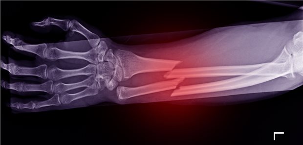 Fraktur von Radius und Ulna: Die Arbeitsgemeinschaft für Arthrosefragen (AO) definiert Pseudarthrosen als Frakturen, die ohne weitere Intervention nicht mehr heilen werden.