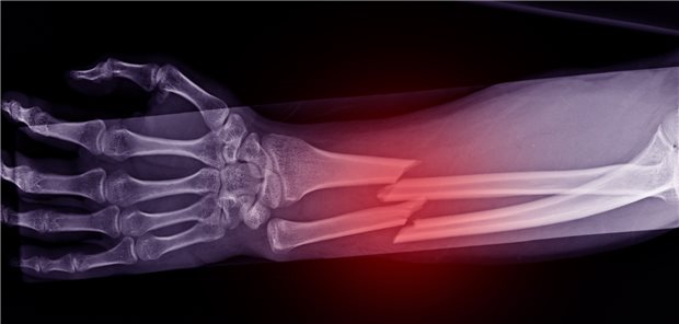 Fraktur von Ulna und Radius: Bei Diabetes behindert hoher Blutzucker die Knochenheilung.
