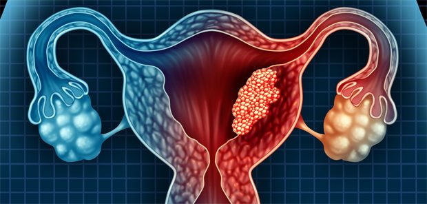 Illustration von Gebärmutter und Eierstöcken. In der Gebärmutter befindet sich ein Tumor.