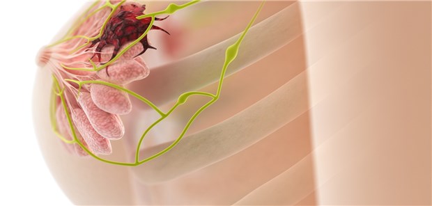 Frauen mit triple-negativem Brustkrebs und N0-Tumor hatten bei einem sTIL- Anteil von mindestens 30 Prozent eine exzellente Prognose.