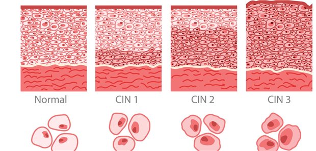 Frauen nach aktiver Überwachung von CIN2 bedürfen kontinuierlicher Kontrollen. Das lässt sich aus den Ergebnissen einer dänischen Studie ableiten.