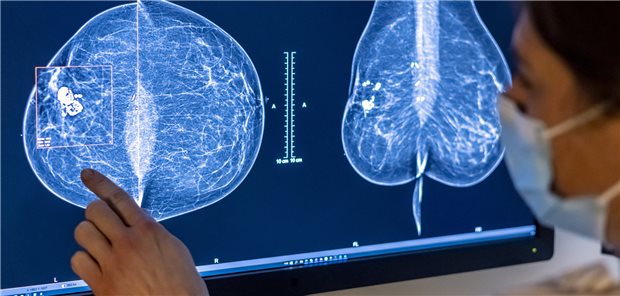 Frauen profitieren von einer genaueren Diagnose, wenn Radiologen und Künstliche Intelligenz Mammographien gemeinsam bewerten, so eine Studie.