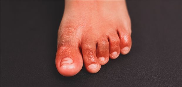 Frostbeulen auf den Zehen: Solche Hauterscheinungen werden häufiger bei COVID-19 registriert.