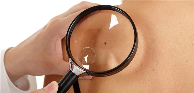 Früherkennungsuntersuchung auf Hautkrebs: Patienten, die mit Thiaziddiuretika behandelt werden, sollten diesen regelmäßigen Check nicht versäumen.