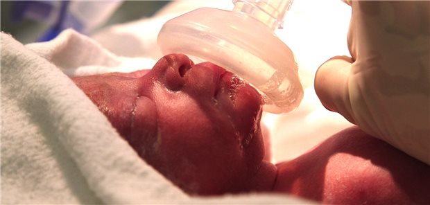 Ein Frühchen erhält eine Atemunterstützung