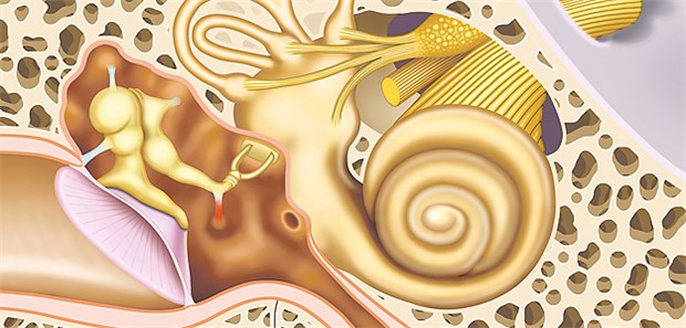 Führen vaskuläre Schäden durch Eisenmangelanämie zu sensorineuralem Hörverlust?