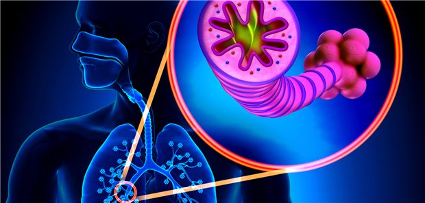 Für COPD gibt es außer Rauchen weitere Risikofaktoren. Ein internationales Forscherteam hat nun eine neue Klassifizierung von fünf COPD-Typen entwickelt.