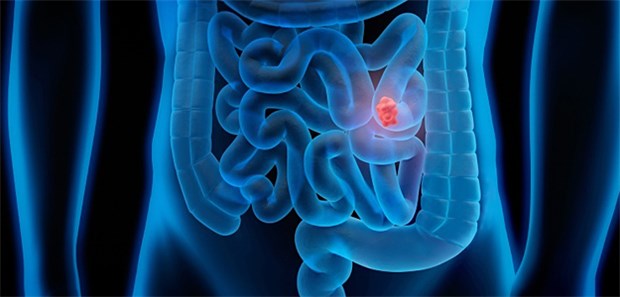 Für Darmkrebs typische Symptome waren bei den Notfallpatienten seltener festzustellen gewesen.