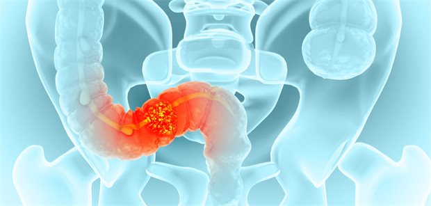 Hervorgehobenes Schema eines kolorektalen Tumors