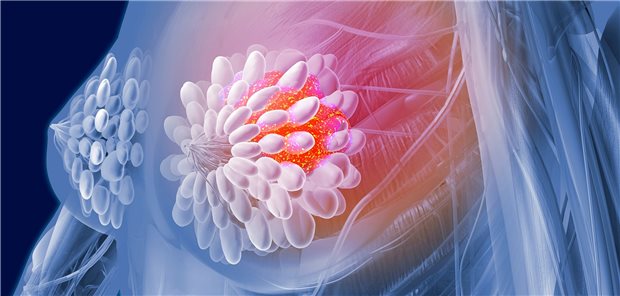 Brustkrebs in der linken Brust, digital dargestellt; Für Frauen mit fortgeschrittenem Brustkrebs bietet die CDK4/6-Inhibition eine gut untersuchte, wirksame Therapieoption.