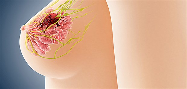 Welche Frauen sind gefährdet? Für Frauen mit hohem Brustkrebs-Risiko steht ein intensiviertes Früherkennungsprogramm zur Verfügung.