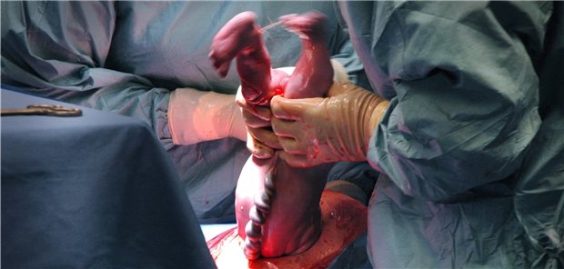 Für Kaiserschnitt zu spät entschieden? Der Bundesgerichtshof musste in einem Fall einer sekundären Sectio entscheiden.