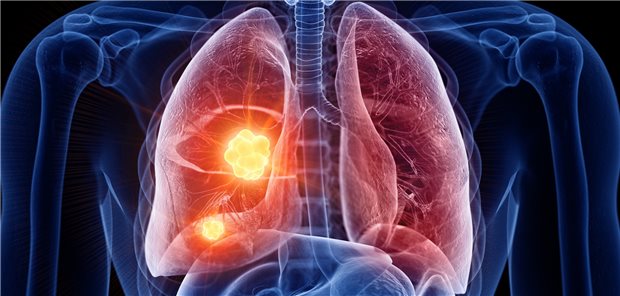 Für Patienten mit RET-Fusions-positivem NSCLC ist mit dem TKI Selpercatinib nun eine zielgerichtete Therapieoption zugelassen.