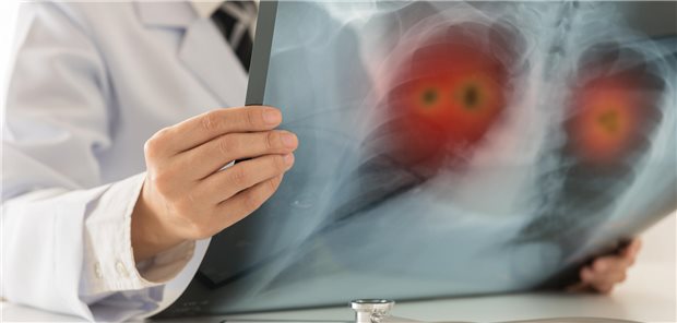 Für Patienten mit fortgeschrittenem NSCLC steht nun eine Immuntherapie zur Verfügung, unabhängig von der PD-L1-Expression. utah51 / stock.adobe.com