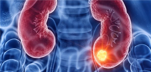 Für Patienten mit fortgeschrittenem Nierenzellkarzinom verbessern sich die
Therapiemöglichkeiten.