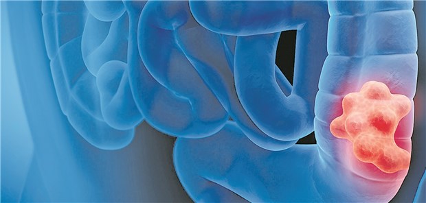 Für Patienten mit metastasiertem Darmkrebs und Rezidiv kann eine Behandlung mit Fruquintinib von Vorteil sein.