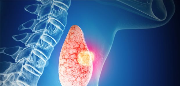 Für RET-getriebene Malignome sind inzwischen selektive Hemmer der RET-Rezeptortyrosinkinase verfügbar.