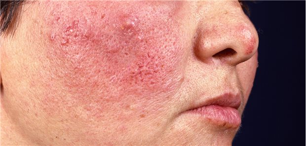 Für Rosazea typisch: Rötung und Knötchenbildung auf Wange. Durch den chronischen Entzündungsprozess in der Haut steigt bei Patientinnen und Patienten mit Rosazea wohl das Risiko für einige Hautkrebsarten.