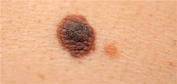 Für die Behandlung von Patienten und Patientinnen mit einem Melanom gibt es neue Daten zu adjuvanten und neoadjuvanten Therapien.