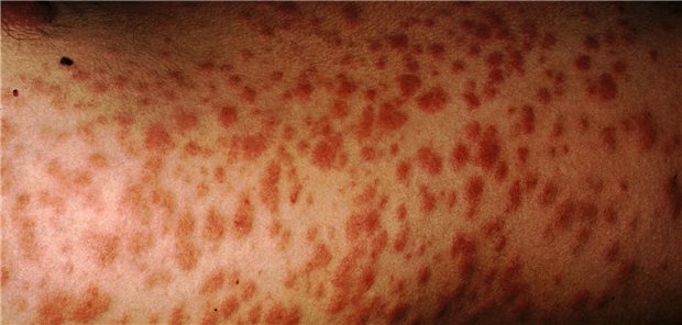 Für die Behandlung von organ- oder lebensbedrohender Granulomatose mit Polyangiitis und Mikroskopische Polyangiitis empfehlen die EULAR-Kriterien als Standard of Care den Einsatz von Rituximab oder Cyclophosphamid in Kombination mit Glukokortikoiden. Neu ist, dass diese nach vier bis fünf Monaten auf 5 mg/Tag reduziert werden sollten, um das Risiko für eine schwere Infektion zu senken.