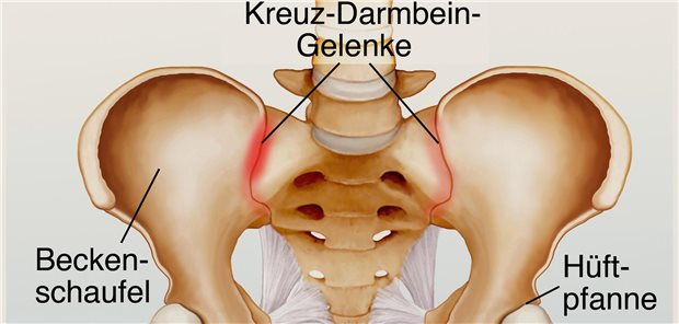 Für die Diagnose einer axialen Spondyloarthritis (axSpA) reicht ein konventionelles Röntgen (CR) oder eine Magnetresonanztomografie (MRT) der Iliosakralgelenke (ISG), auch als Kreuz-Darmbein-Gelenke bekannt, nicht aus. Erst in Kombination der Bildgebung mit klinischen Informationen ist eine spezifische uns sensitive Diagnose möglich.