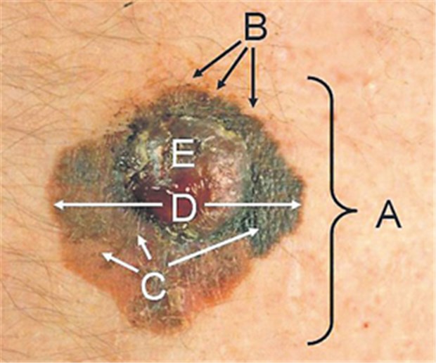 Kampagnen drängen Hautkrebs zurück Für die Früherkennung des Melanoms hat sich die ABCDE-Regel bewährt: A: Asymmetrie, B: Begrenzung, C: Colorit (Farbe), D: Durchmesser und E: Erhabenheit/Entwicklung.