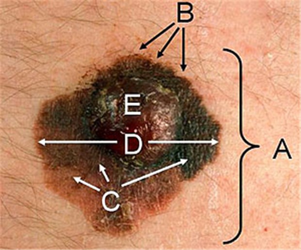 ABCD-Regel versagt bei jungen Patienten Für die Früherkennung des Melanoms hat sich die ABCDE-Regel bewährt - nur bei Kindern nicht.
