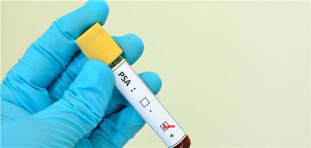 „Raus aus der Diskussion mit dem IQWiG“ zum Thema Prostata-Ca Für die Früherkennung von Prostatakrebs wird der PSA-Test weiterhin eine zentrale Rolle spielen.