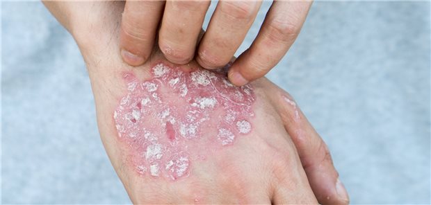Für die Therapie von Autoimmundermatosen wie Psoriasis kommen auch Januskinaseinhibitoren infrage.