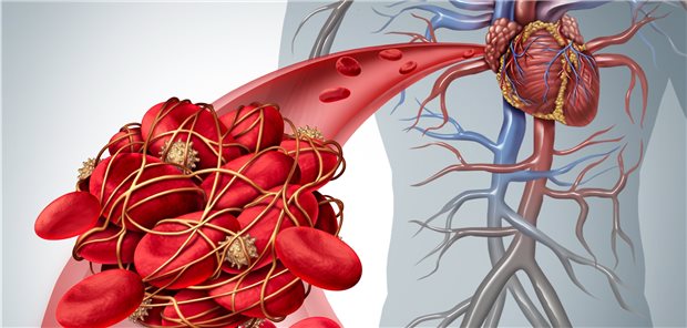 Für die langfristige Monotherapie mit einem Thrombozytenhemmer nach PCI gibt es mit Clopidogrel möglicherweise eine effizientere Option als ASS.