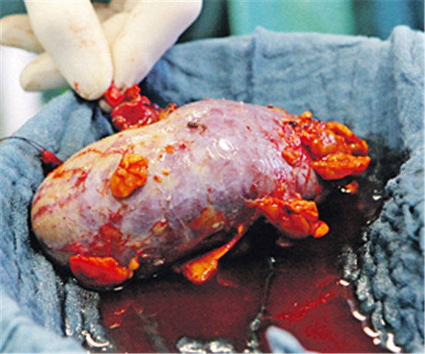 Immer mehr Ältere spenden Nieren Für eine Transplantation vorgesehene Spenderniere.