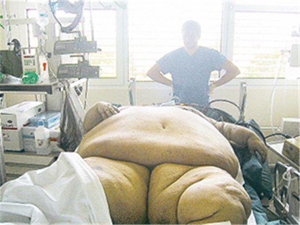 Magenbypass ist keine Lifestyle-Chirurgie, doch der Erfolg hat seinen Preis Für einige adipöse Patienten ist Chirurgie der letzte Ausweg.
