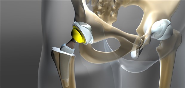 Aufbau eines Implantate-Registers abgesegnet Für mehr Sicherheit und Qualität bei Implantaten soll ein bundesweites staatliches Register aufgebaut werden. Unter den zunächst zu erfassenden Implantaten gehören auch die für die Hüfte.