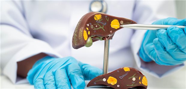 Ein Arzt erläutert seinem Patienten mit Fettlebererkrankung anhand eines Anatomiemodell der Leber die prognostischen Risiken.