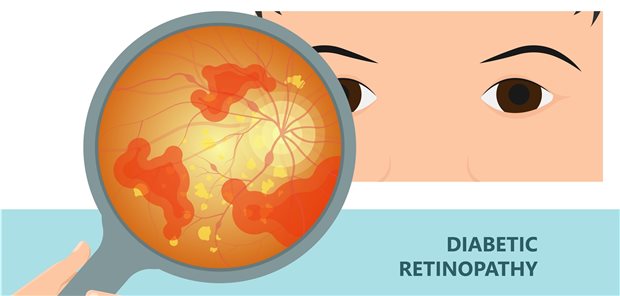Fundus bei diabetischer Retinopathie: Gefäße mit Aneurysmen und Einblutungen.