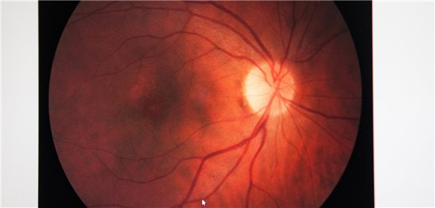 Fundus eines Patienten mit einem Makulaödem. Ist dies Folge einer Uveitis, bleibt es häufig trotz Behandlung bestehen oder rezidiviert.