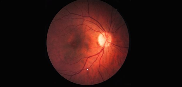 Fundusskopie von einem Patienten mit Makulaödem.
