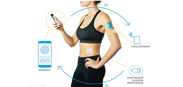 Funktionsweise eines Hybrid-Closed-Loop: Dargestellt ist das System DBLG1 von Diabeloop (und nicht das im Text erwähnte „Control IQ“). Das DBLG1 besteht aus einem CGMSensor (Dexcom G6) sowie einer Patch-Insulinpumpe und einem Handset. Mit dem Handset wird anhand der Messwerte des Glukosemonitors die Insulinfreisetzung der Pumpe gesteuert. Die Komponenten sind via Bluetooth miteinander verbunden.