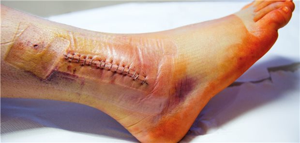 Für die Belastbarkeit des Sprunggelenks nach der Op ist womöglich die Verwendung bestimmter Schienen zuträglich.