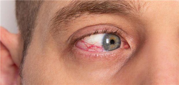Nahaufnahme eines roten männlichen Auges mit beschädigten Blutgefäßen aufgrund einer Uveitis. 